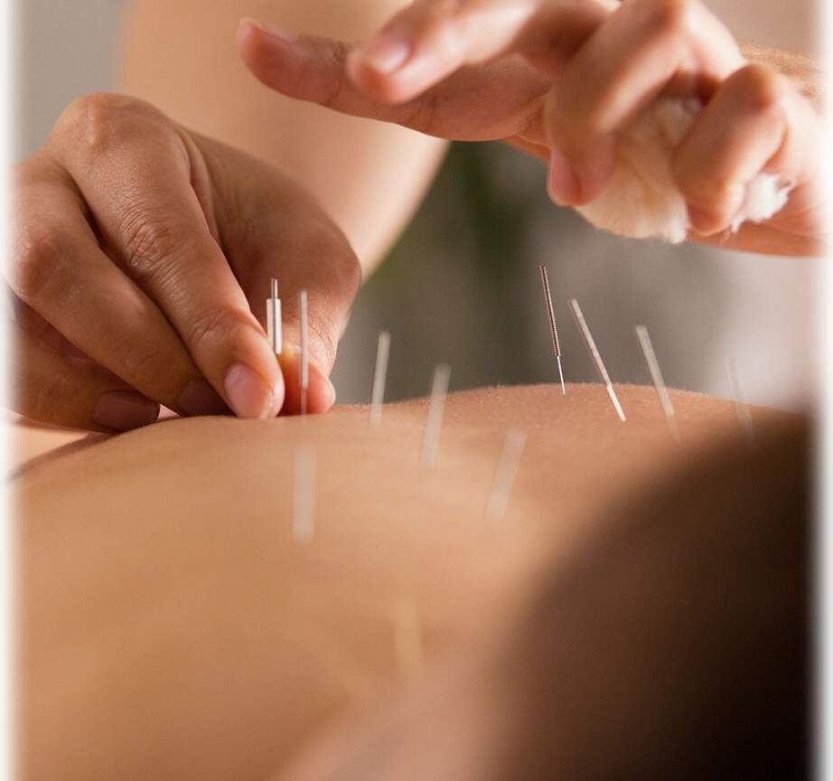 Masáž suchou ihlou