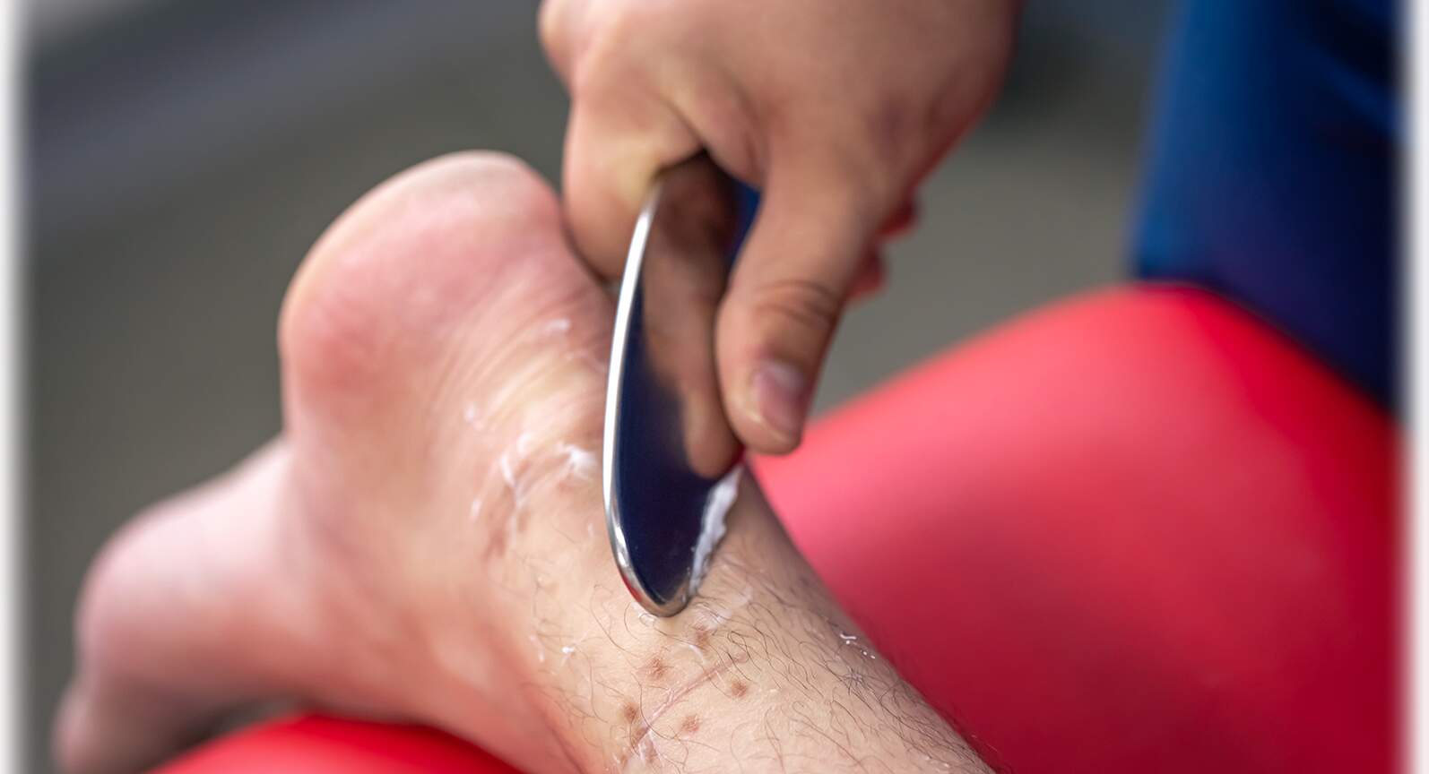 IASTM - mobilizácia mäkkých tkanív pomocou inštrumentov