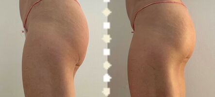 Lymfocontouring - Brazílska lymfodrenáž